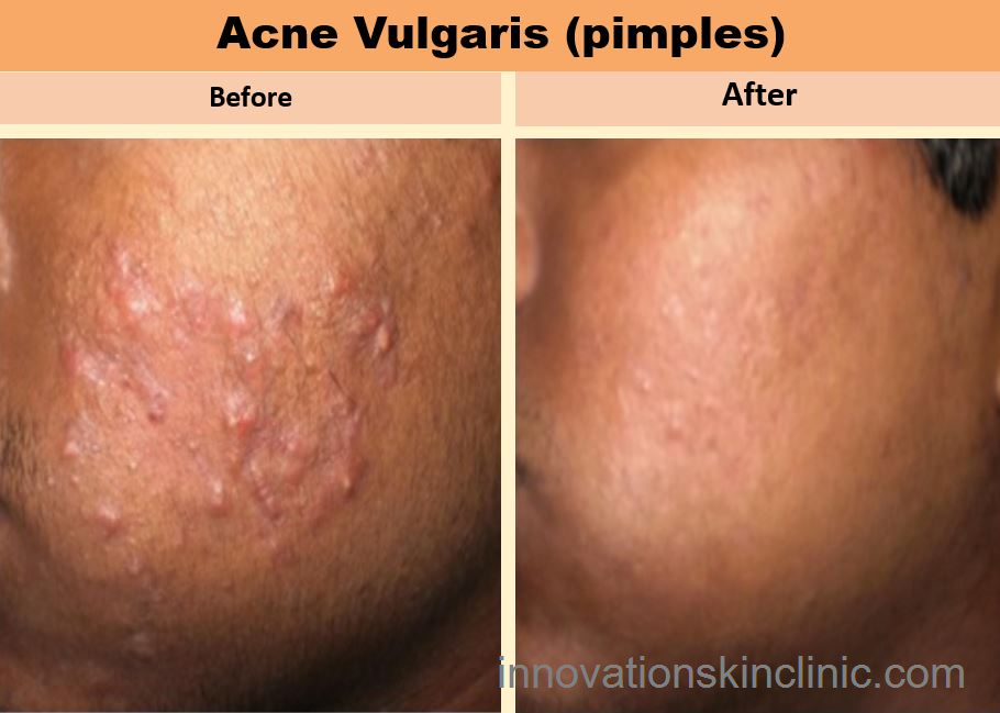 Acne Vulgaris Pimples 2